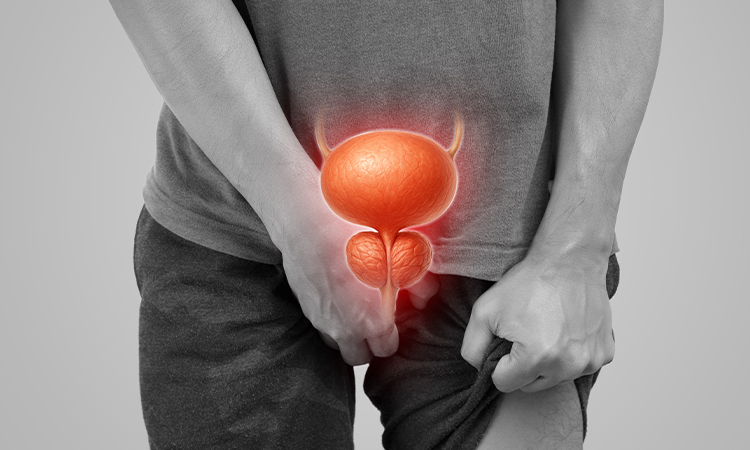 Prostate Cancer Burden Rising In Nigeria, Expert Warns