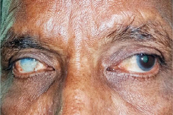 Nigeria’s Search For Sustainable Eye-Care Funding