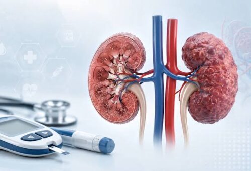 Hypertension, Diabetes Raise Kidney Failure Risk – Expert